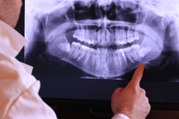 Best Emergency Wisdom Teeth Removal in Colfax, WI